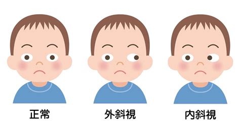 斜視 影響|斜視：どんな症状？原因やリスクは？自分で対処する。